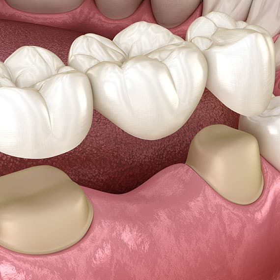 Dental Bridges in Vancouver