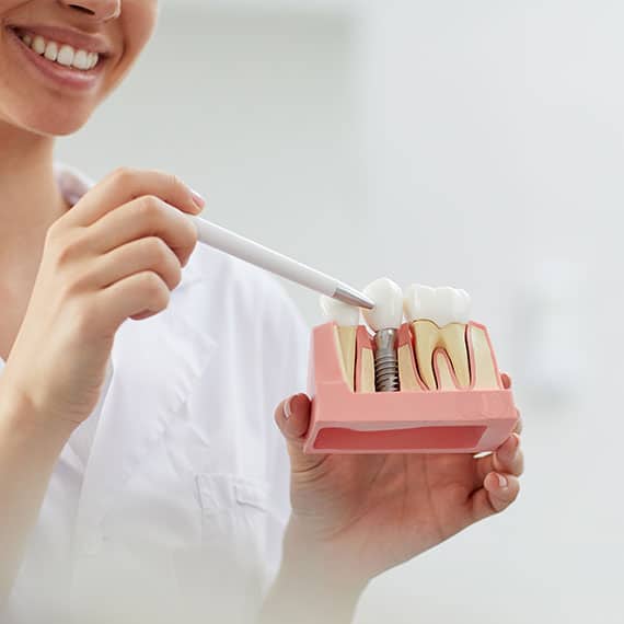 Dental Implants in Vancouver