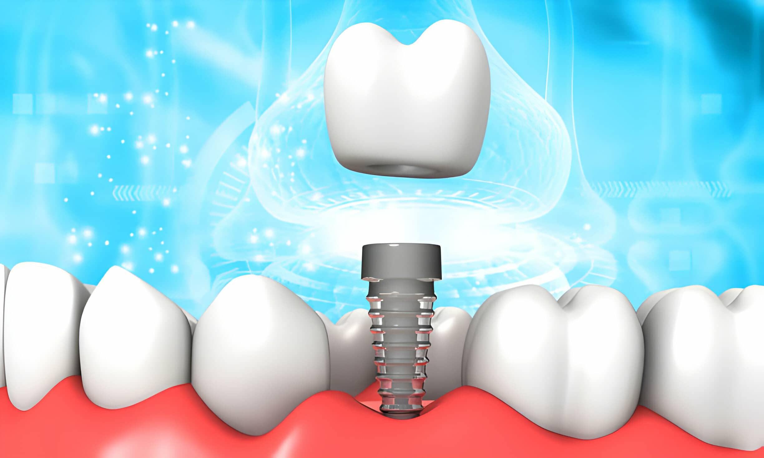 Are Dental Implants The Best Option For A Natural-Looking Smile?