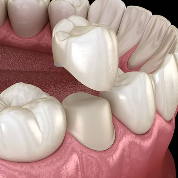 Dental Crowns in Vancouver