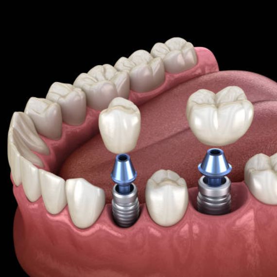 tooth implant in vancouver bc