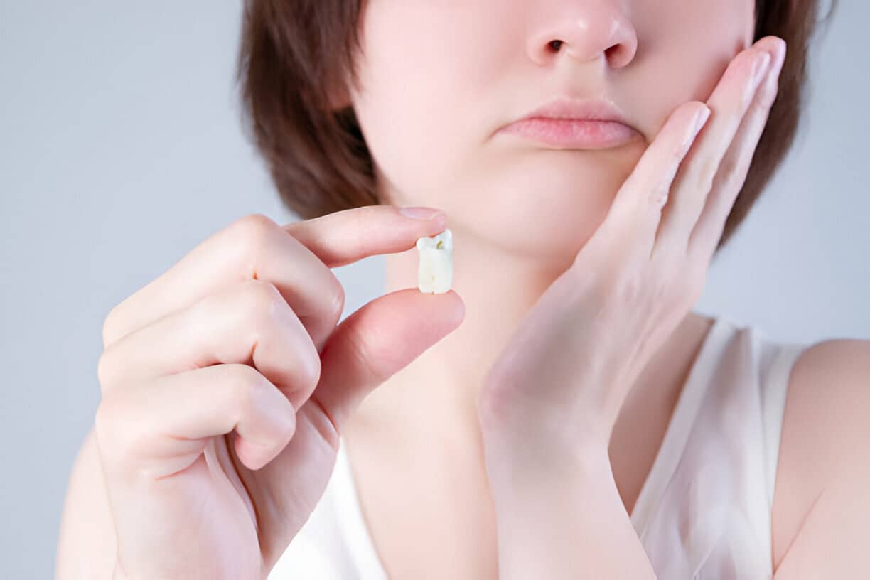 How Many Days To Recover From Wisdom Tooth Extraction?
