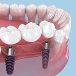 can-i-get-dental-implants-if-i-have-bone-loss