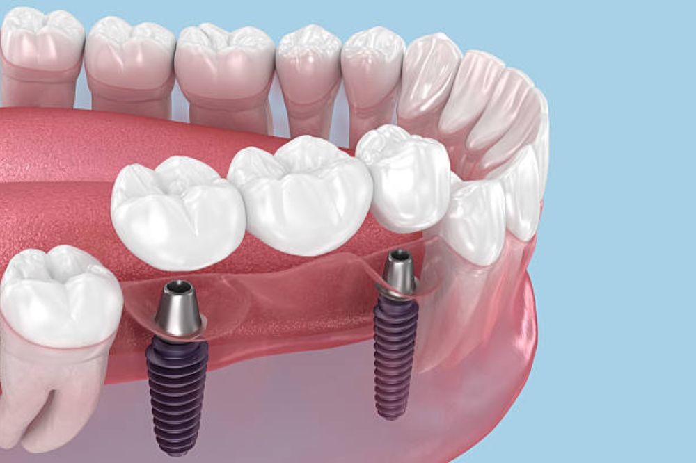 can-i-get-dental-implants-if-i-have-bone-loss