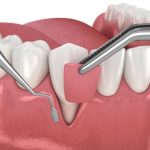 is-the-pinhole-technique-better-than-gum-grafting