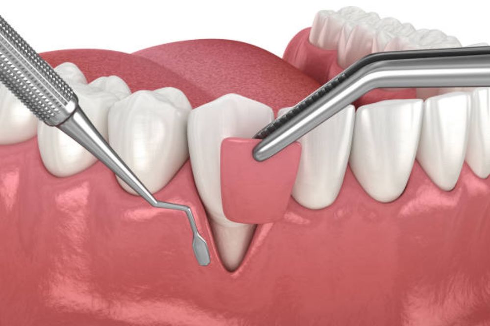 is-the-pinhole-technique-better-than-gum-grafting
