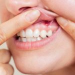 _what-happens-if-periodontal-disease-is-left-untreated