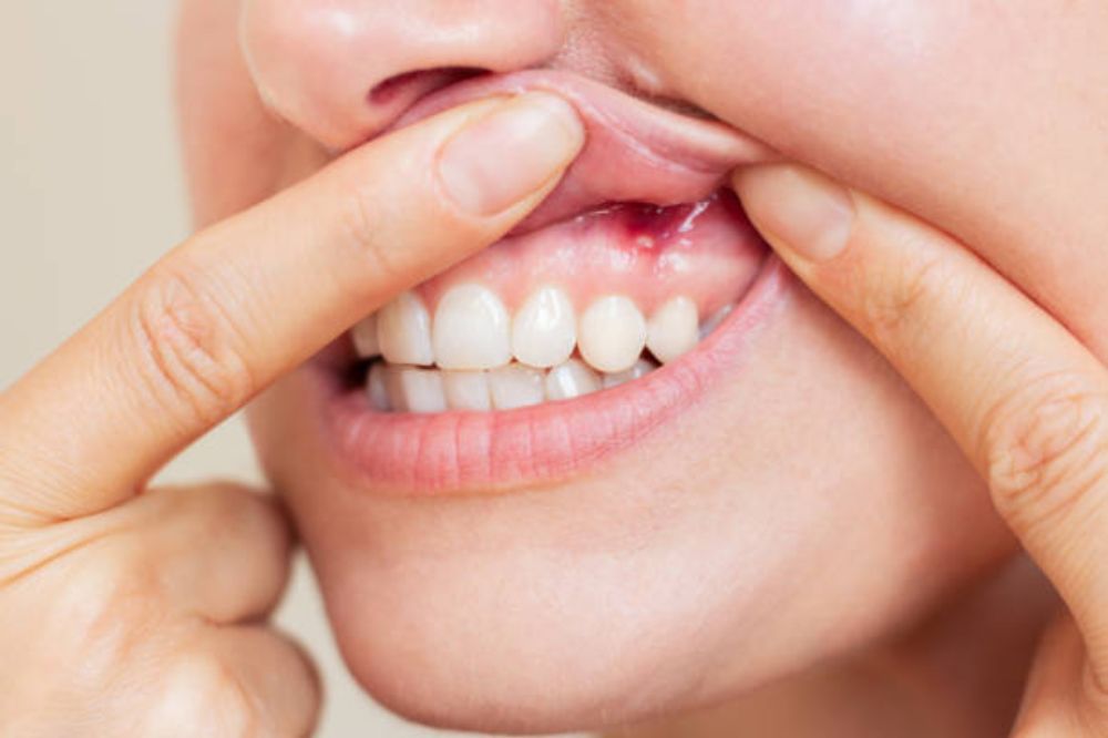 _what-happens-if-periodontal-disease-is-left-untreated