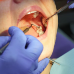 What To Expect During Wisdom Tooth Removal?