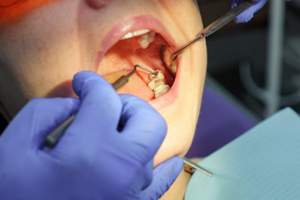 What To Expect During Wisdom Tooth Removal?